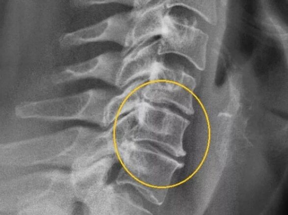 Emakakaela lülisamba osteokondroos x -ray